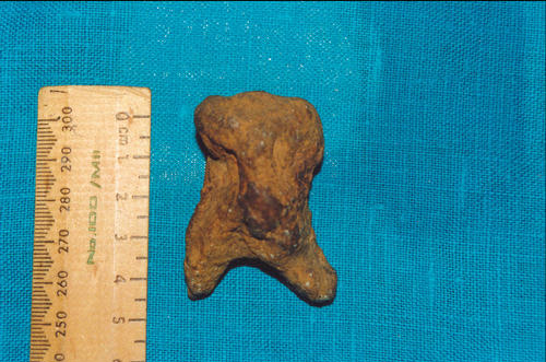 Giant Pre-Molar Tooth